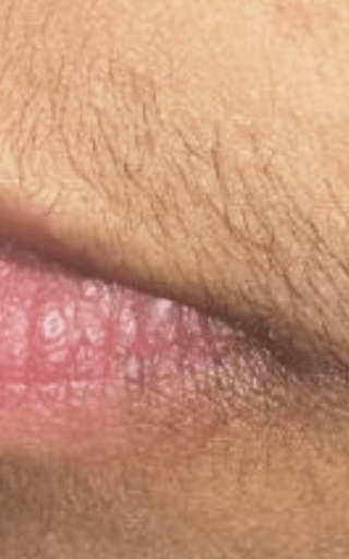 Motus PRO - Versatile Hair Removal, Skin Revitalization & Lesion ...