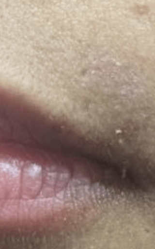 Motus AZ+ - Versatile Hair Removal, Skin Revitalization & Lesion ...
